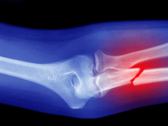 x-ray of broken arm with red circle overlay on the fracture site