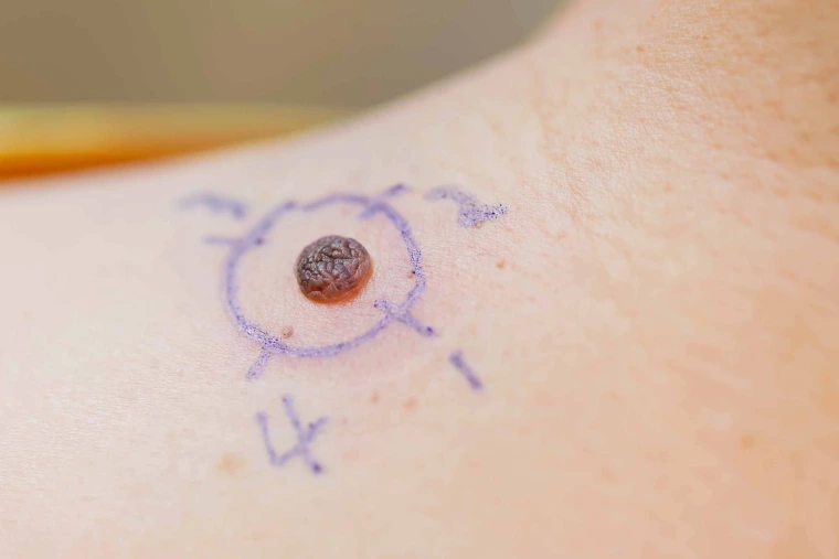 Mole with cirle around it and numbered 1 to 4