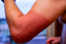 Sunburn on a person’s arm